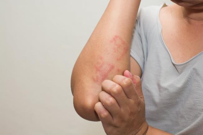 אישה סובלת מפריחה בעור שעלולה להיות תסמין של קורונה 